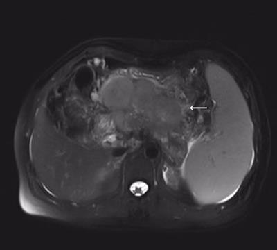 Case Report: Squamous Cell Carcinoma of Pancreas With High PD-L1 Expression: A Rare Presentation